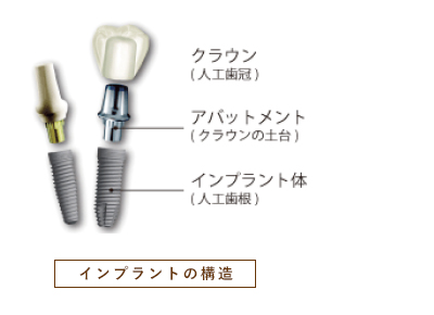 インプラントの構造